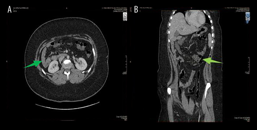 The small bowel (deep green arrow) seen at the right side of the abdomen and the cecum (bright green arrow) seen at the left side of the abdomen.
