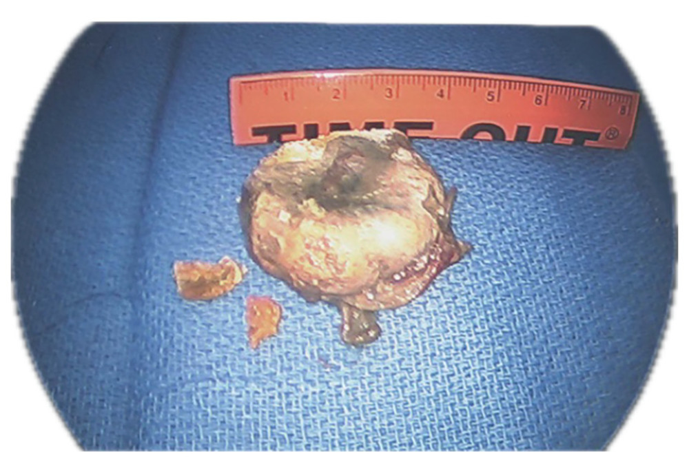 Image of gallstone removed from distal small bowel.