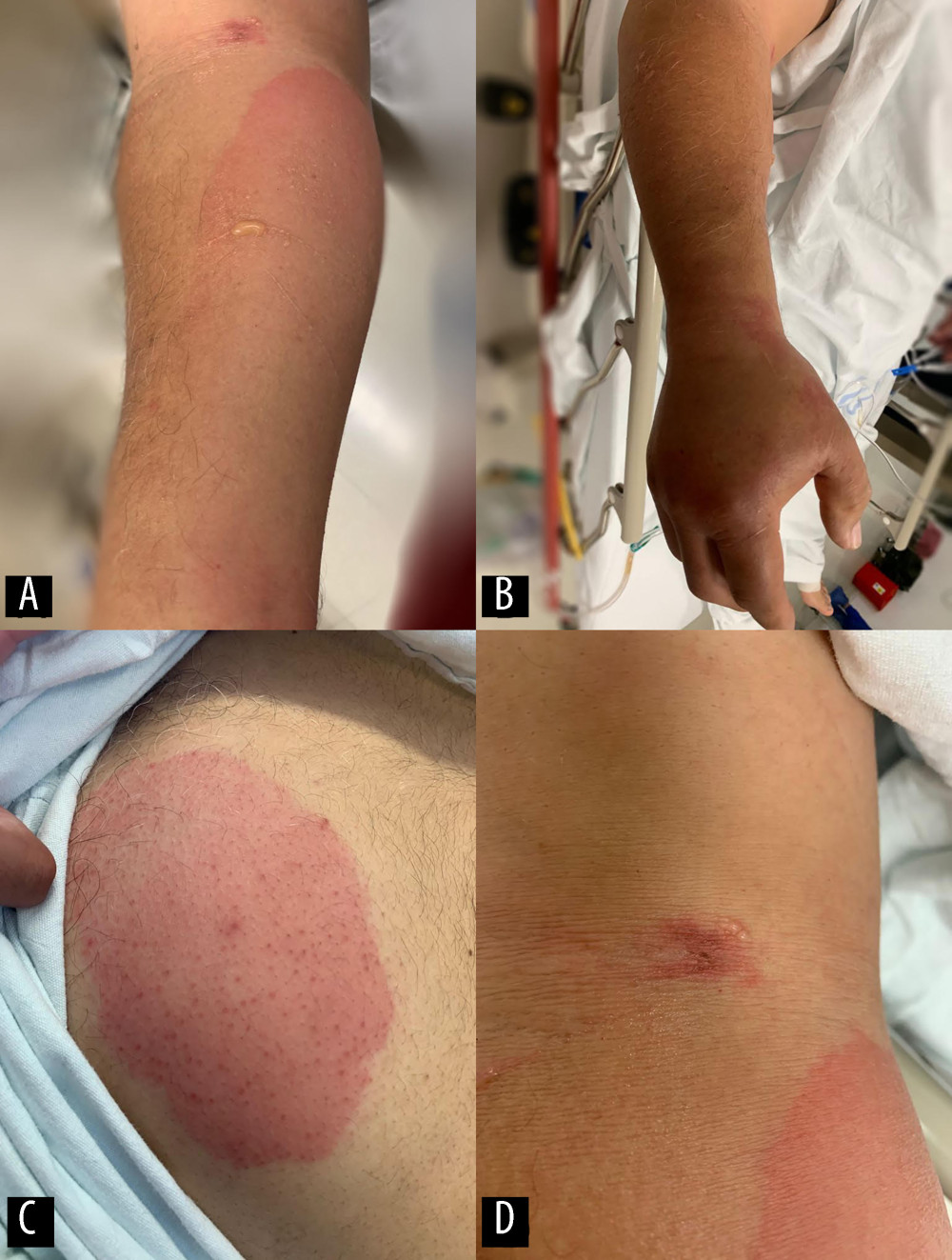 (A, B) Localized dermatosis on the right forearm consisting of a well-circumscribed erythematous plaque extending from 5 cm below the antecubital crease to the fingers of the hand (flictenas are also observed). (C) Presence of a well-defined erythematous plaque of approximately 10×10 cm in the right sub-mammary region, with no necrotic center appreciated. (D) Hyperchromic lesion in the antecubital fold with a necrotic center, the presumed site of the arachnid bite.
