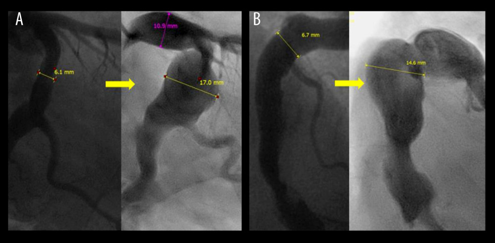 Coronary angiography images showing gradual changes over time of left coronary artery (A) and right coronary artery (B). The left side of each image shows the coronary artery ectasia at the age of 54 years. The right side presents the giant aneurysms more than 10 years later.