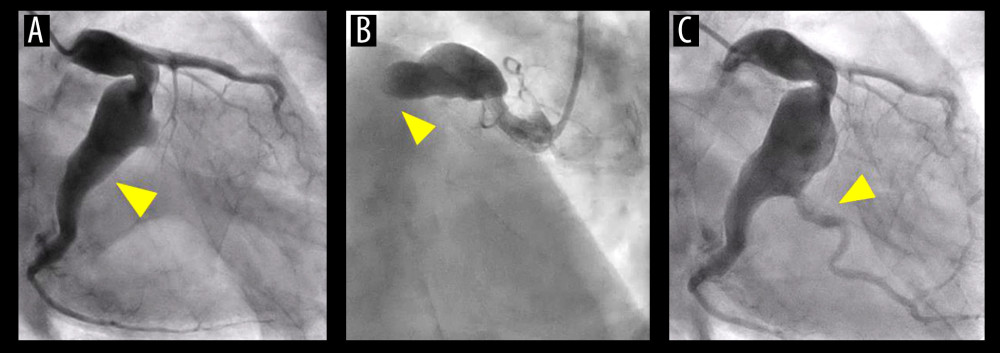 Emergency coronary angiography images show simultaneous total occlusions in the posterolateral branch of the left circumflex artery (A) and proximal right coronary artery (B) (triangular arrows). (C) A post-balloon angioplasty image shows thrombolysis in myocardial infarction grade II in the posterolateral branch of the left circumflex artery (triangular arrow).