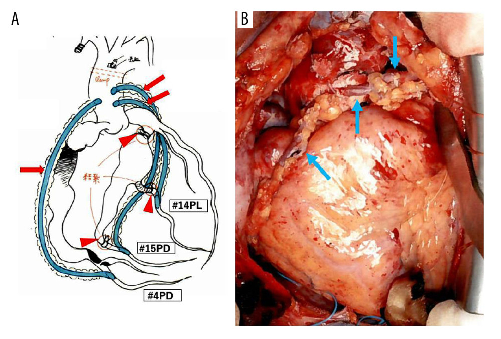 (A) An intraoperative illustration shows coronary artery bypass grafting using saphenous vein grafts (arrows) harvested using the “no-touch” technique in combination with left circumflex artery aneurysm ligation (triangular arrows). (B) An intraoperative image shows saphenous vein grafts harvested using the “no-touch” technique (arrows).
