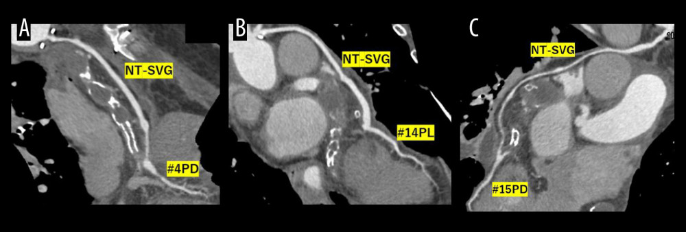 Coronary computed tomography angiography (CCTA) images of the bypass grafts on postoperative day 8. Curved multi-planar reconstruction of CCTA images show the good patency of saphenous vein grafts, harvested using the “no-touch” technique, in the right coronary artery (A) and the left circumflex artery (B, C). #4PD: posterior descending branch of the right coronary artery, #14PL: posterolateral branch of the left circumflex artery, #15PD: posterior descending branch of the left circumflex artery.