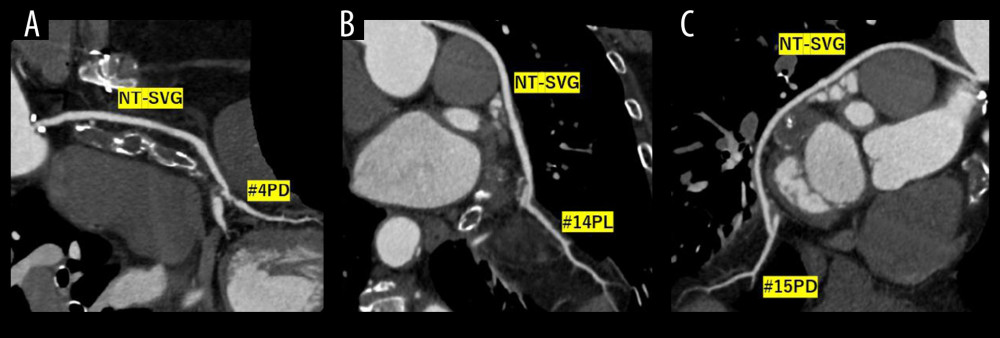 Coronary computed tomography angiography (CCTA) images of the “no-touch” saphenous vein grafts (NT-SVG) at 4 years postoperatively. All the NT-SVGs show good patency in the right coronary artery (A) and the left circumflex artery (B, C).