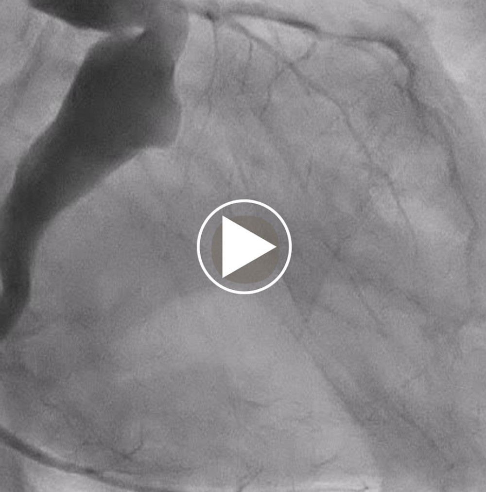 Total occlusion of the left circumflex artery revealed by the emergency coronary angiography.