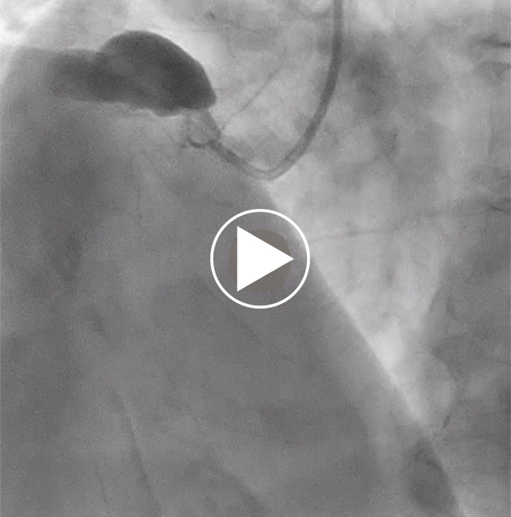 Total occlusion of the right coronary artery.