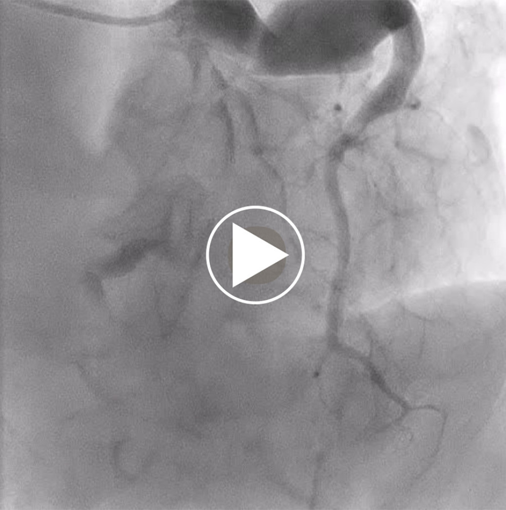 Collateral blood channels extending from the left coronary artery to the distal portion of the right coronary artery.