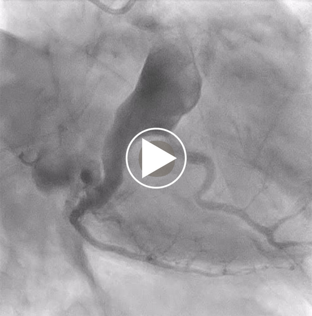 Thrombolysis in the myocardial infarction grade II in the posterolateral branch of the left circumflex artery after percutaneous coronary intervention.