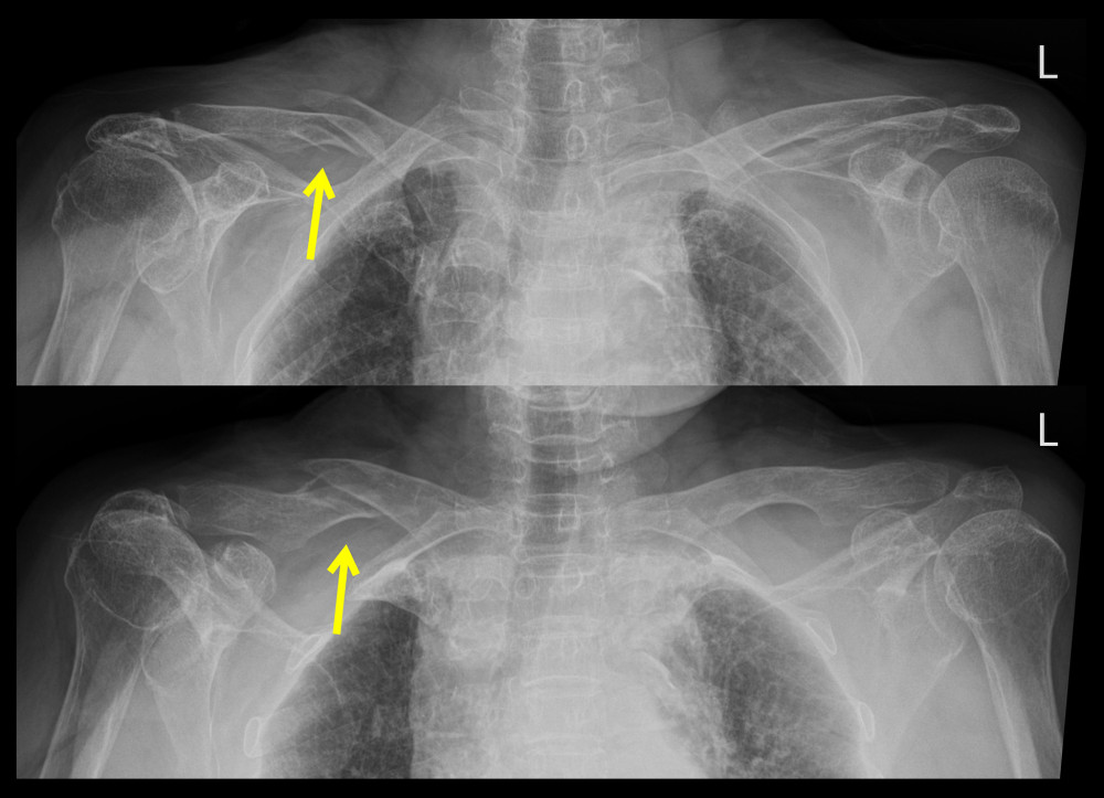 Initial X-rays showing a displaced fracture of the right clavicle shaft (arrows).