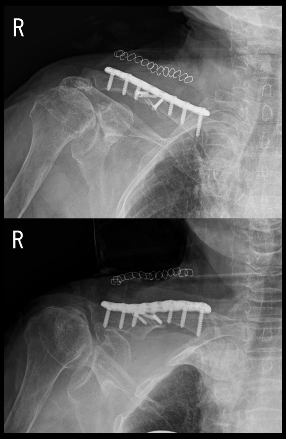 Immediate postoperative X-rays. Open reduction and internal fixation using a standard superior locking compression plate.