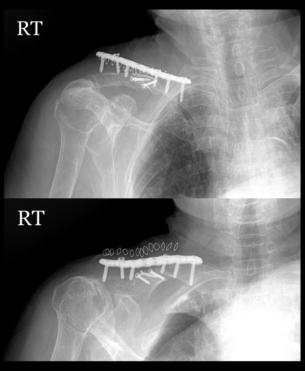 Postoperative 2-week X-rays showing plate migration and pull-out from the clavicle.