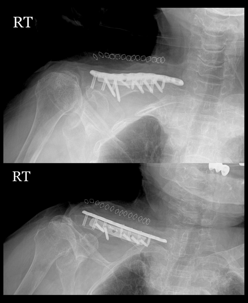 X-rays after revision surgery using superior and anterior dual plating.