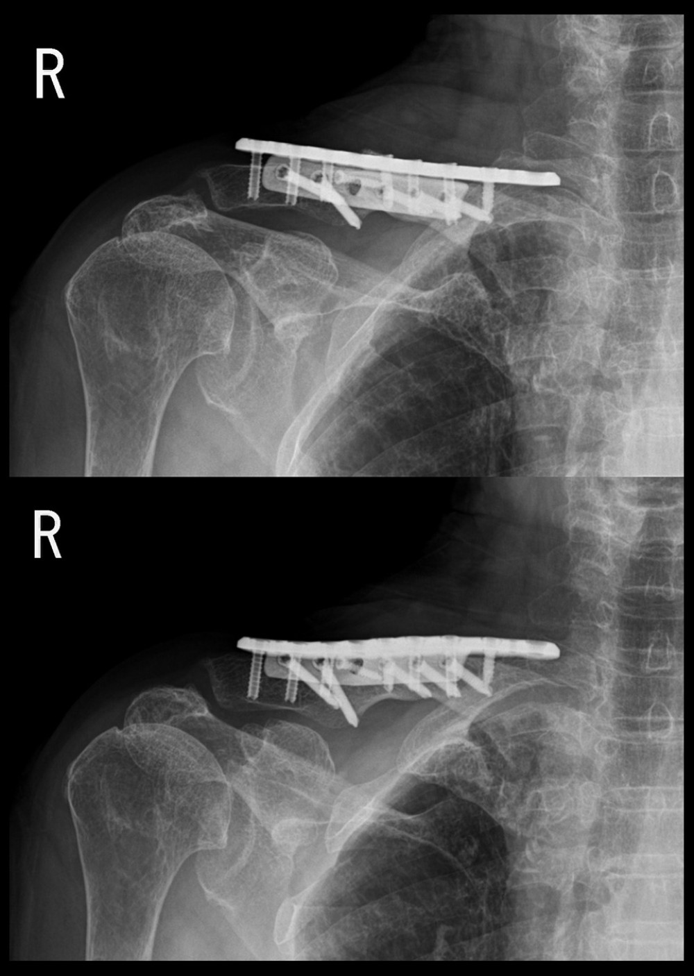Postoperative 1-year X-rays showing successful fracture healing.