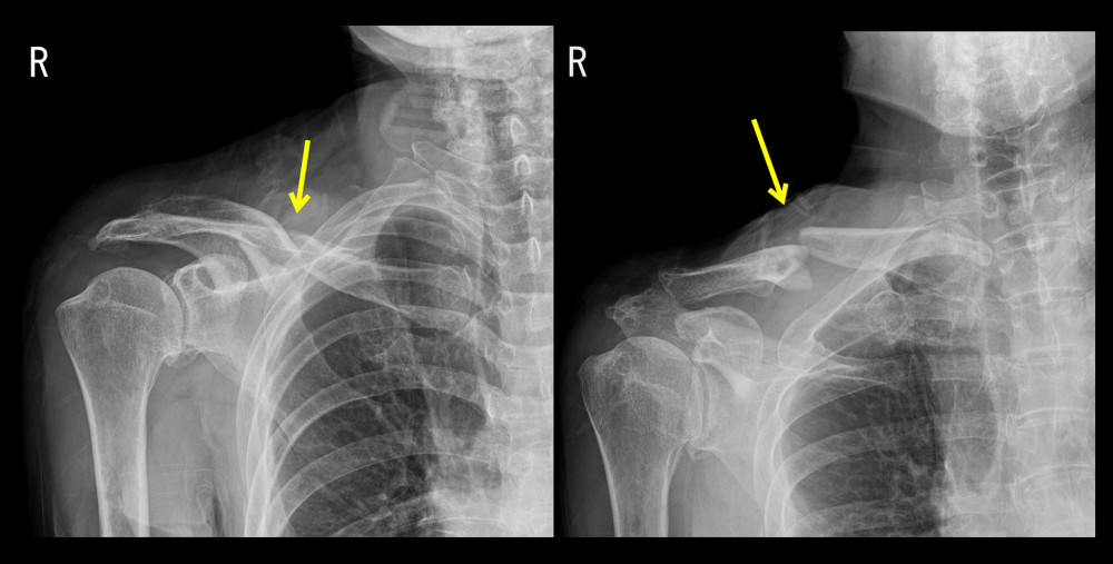 Initial X-rays showing a displaced fracture with a butterfly fragment of the right clavicle shaft (arrows).
