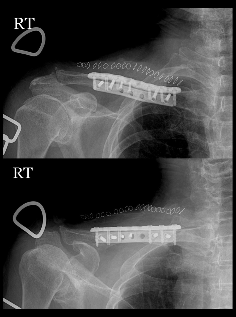 Immediate postoperative X-rays. Open reduction and internal fixation using superior and anterior dual plating.