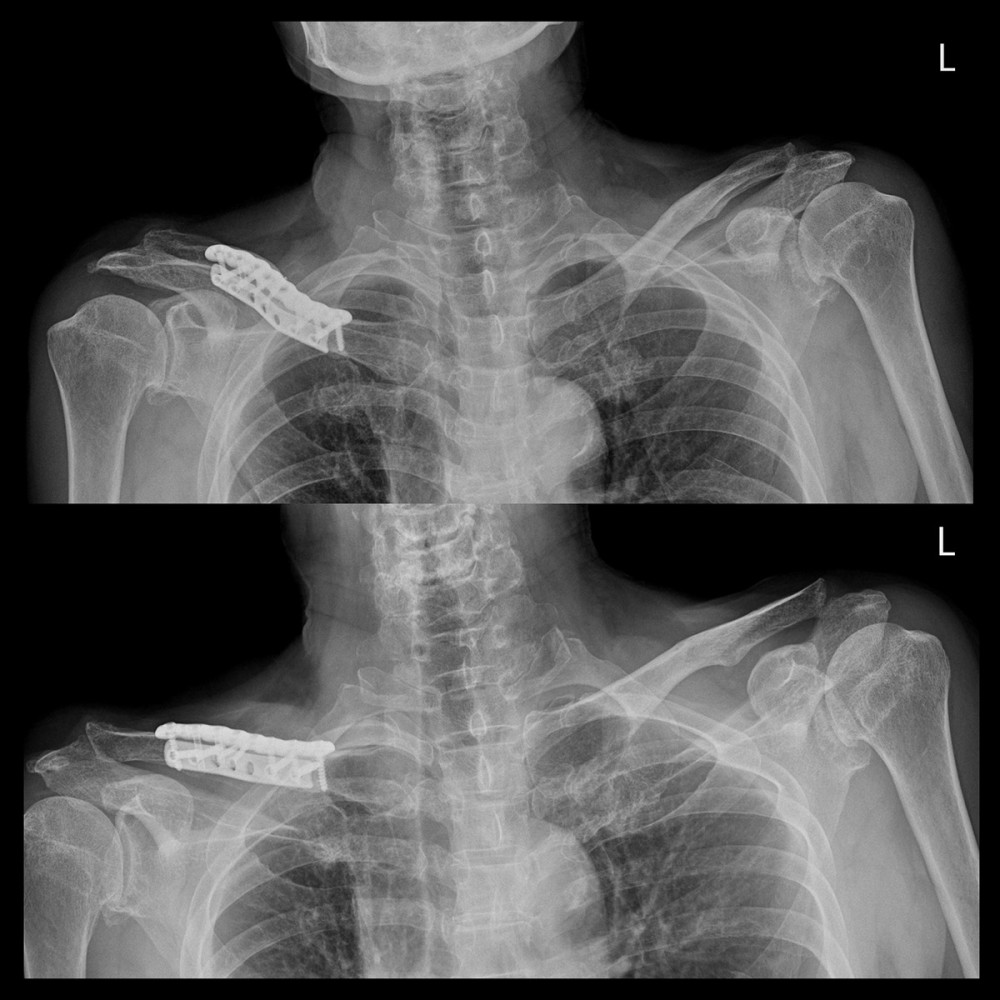 Postoperative 6-month X-rays showing successful fracture healing.