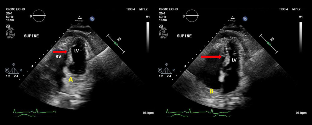 Transthoracic echocardiogram. Red arrows show a septal bounce sign moving through the cardiac cycle (A to B in yellow). RV is the right ventricle, and LV is the left ventricle. The early diastolic filling of the right ventricle leads to the leftward deviation of the interventricular septum followed by a bounce back towards the right ventricle in late diastole. This results from increases in early diastolic pressure in the right ventricle that exceeds left ventricular diastolic pressures during the cardiac cycle. The septal bounce is explained as a rapid and asymmetric filling of ventricles in early diastole, resulting in an intracardiac fluctuating pressure gradient that manifests as an abrupt shift of the septum.