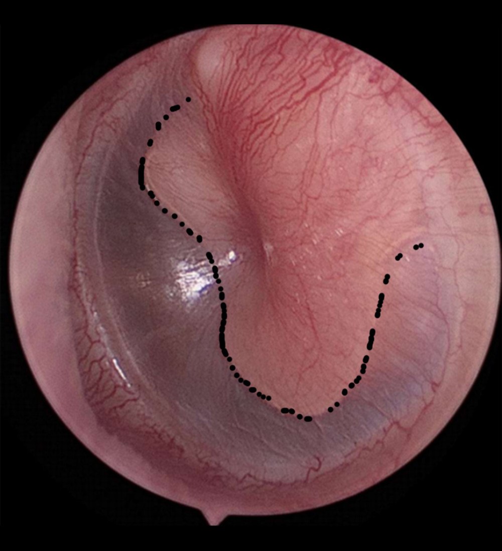 Using an ear endoscope, a pink neoplasm was observed in the retracted left tympanic membrane (indicated by the black dashed line).