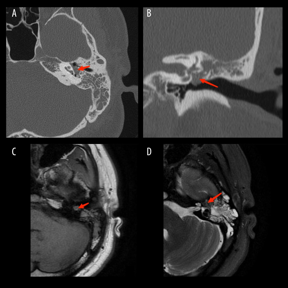 (A) Axial position: medium tympanic and mastoid cavity soft tissue density imaging. (B) Coronal position: The axis position of the ossicular chain is surrounded by soft tissue density shadow. (C) T1W1: slightly higher signal. (D) T2WI: flake high signal image (red arrow).
