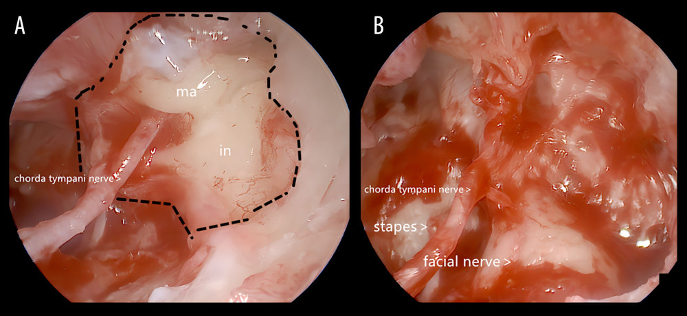 (A) Before the tumor was removed. The tumor is outlined by the black dotted line. (B) After the tumor was removed, the chordae tympani nerve and facial nerve were intact.