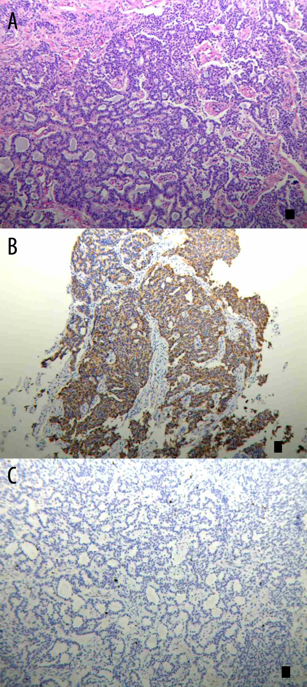 (A) HE Staining: Fibrous connective tissue contains irregularly arranged cell nests, forming glandular or solid structures. The cell nuclei are hyperchromatic with fine chromatin. Mitotic figures are rare. No necrosis is observed. (B) Immunohistochemical examination: synaptophysin shows diffuse positive staining. (C) Immunohistochemical txamination: Ki67 shows approximately 2% positivity.