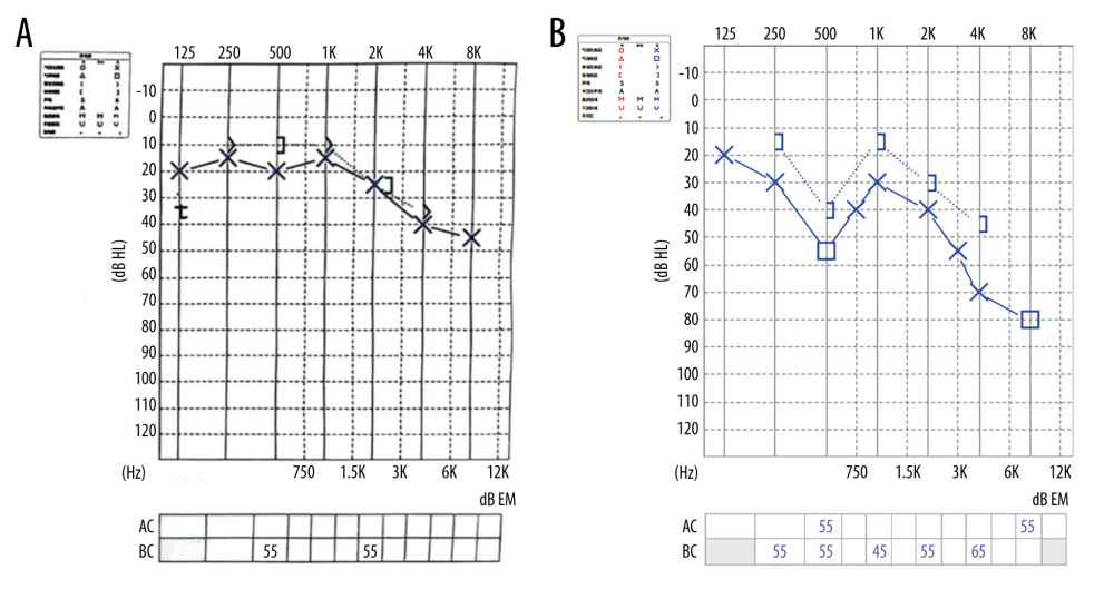 (A) PTA before the operation. (B) PTA after the operation.