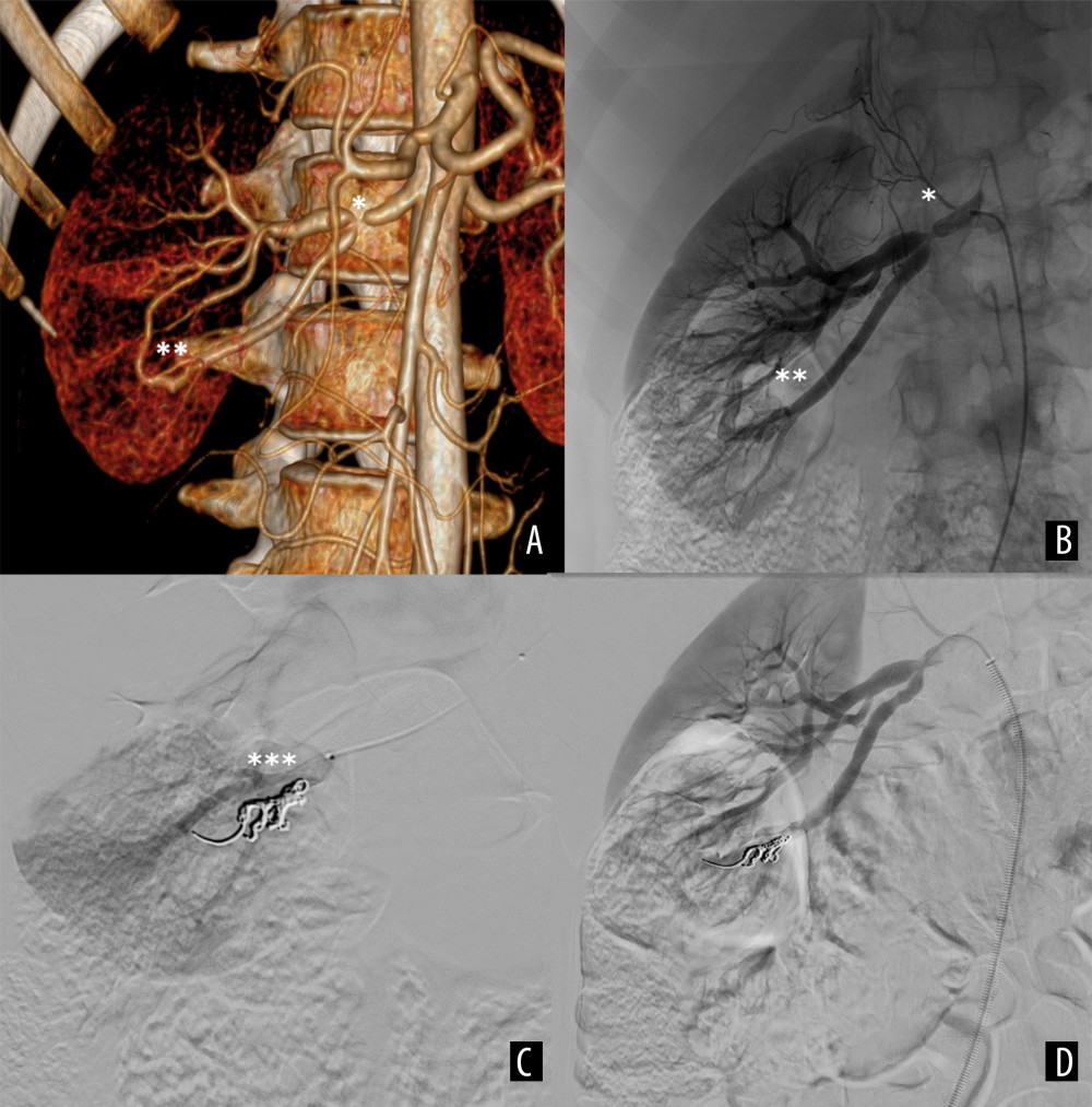 First procedure. (A) Preprocedural computed tomography angiography (CTA) presenting stenosis (*) and fistula (**); (B) preprocedural digital subtraction angiography (DSA) with stenosis (*) and fistula (**); (C) DSA after fistula closure with coils (***); (D) the result of balloon angioplasty of the stenosis.
