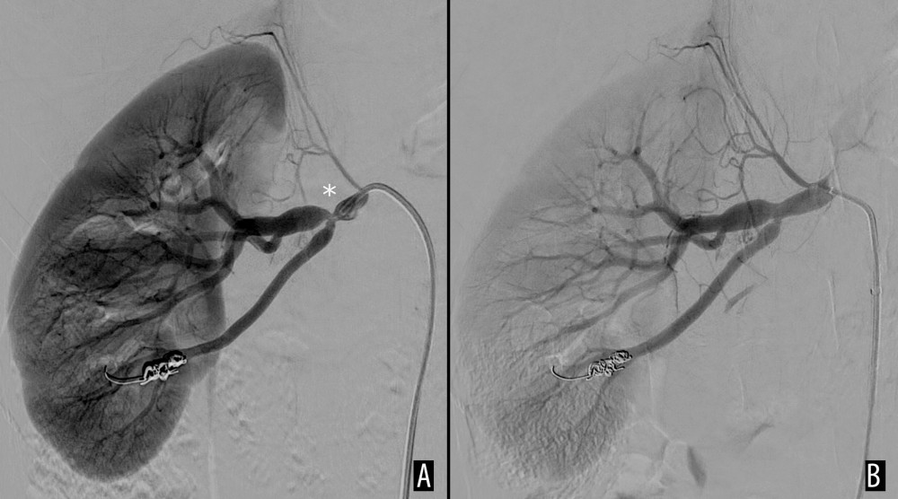 Second procedure: (A) Initial digital subtraction angiography presenting restenosis (*) or right renal artery; (B) final effect of balloon angioplasty of the stenosis.