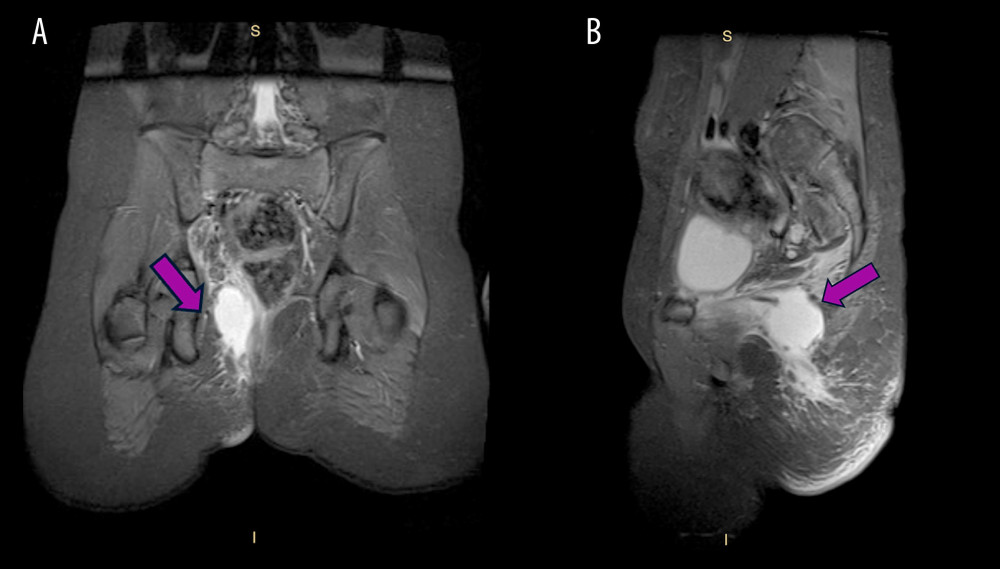 (A, B) Coronal and sagittal T2-weighted perineum MRI shows an abscess in the right ischiorectal fossa (arrow).