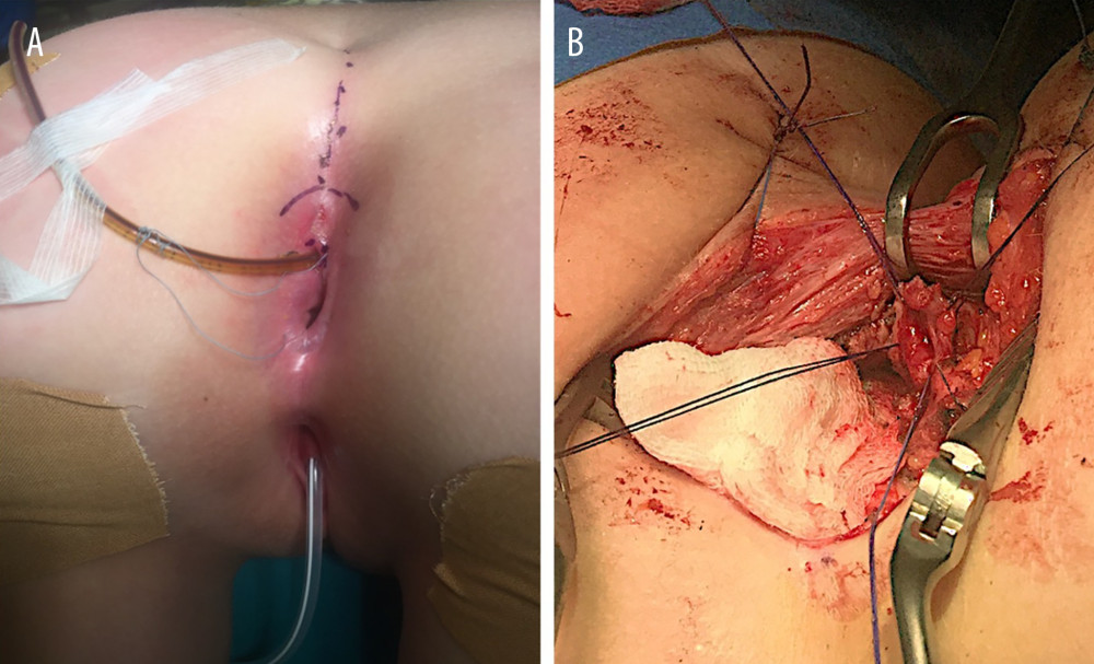 Intraoperative pictures. (A) The patient was positioned prone. A tubular drainage catheter had previously been inserted into the ischiorectal abscess through the fistula, which had a small opening just below the pectineal line. (B) Traction sutures were used to isolate the fistula between the accessory opening and the abscess in the right ischiorectal fossa.