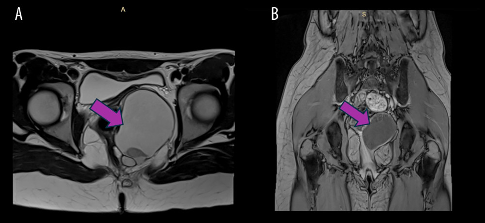 (A, B) Axial and coronal T2-weighted perineum MRI shows an abscess in the left ischiorectal fossa (arrow).