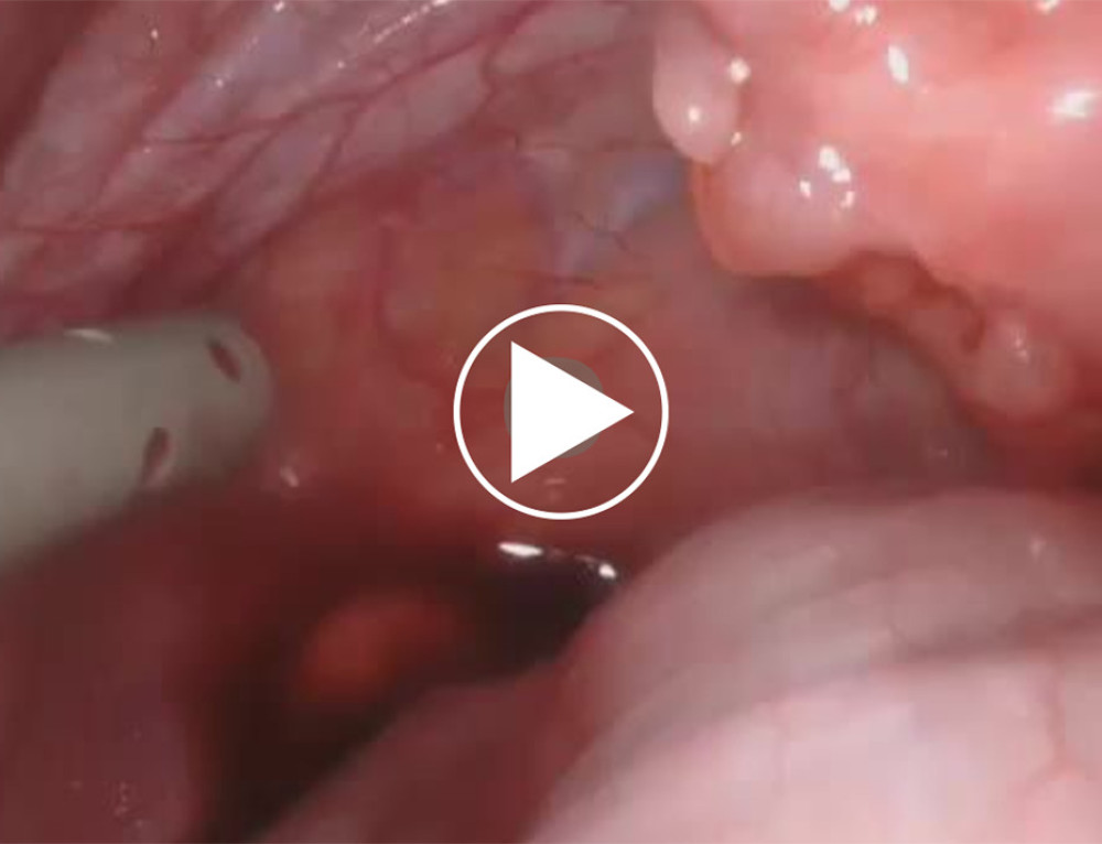 Surgical access was achieved using a supraumbilical camera port and 2 additional ports on the umbilical line. Intraoperative colonoscopy assisted in detaching the cyst from the rectum, while stay sutures retracted the bladder, uterus, and vagina. Indocyanine green was injected, which helped precisely separate the cyst from the surrounding muscles, allowing its extension below the peritoneum into the pelvic floor. Complete excision of the cyst was achieved after its puncture.