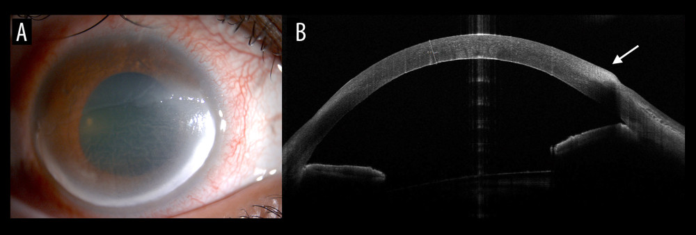 (A) Slit lamp photograph of the right eye at initial presentation, showing a mild conjunctival injection, inferior corneal ring ulcer extending around the 6 o’clock position and separated from the limbus with a 1-mm area of corneal thinning, with corneal edema, Descemet folds, and an overlying epithelial defect of 8×11 mm. (B) Anterior segment optical coherence tomography showing a peripheral anterior stromal opacity (hyper-reflectivity, white arrow) at the site of the ring infiltrate.