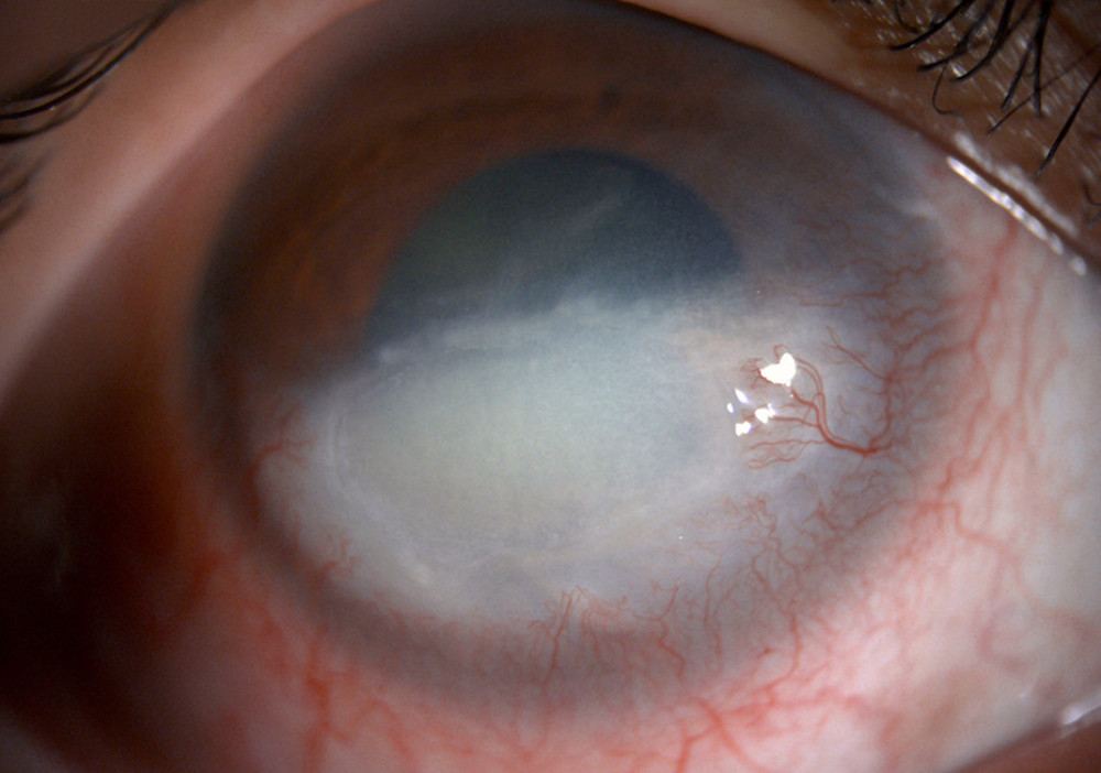 Slit lamp photograph taken 6 months after the initial presentation, showing a scarred inferior cornea with neovascularization and a persistent epithelial defect measuring 3.5×5 mm.