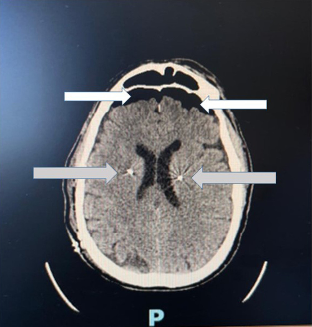 Magnetic resonance imaging of the brain showing correct positioning of the electrodes bilaterally, with identification of a moderate amount of air (pneumocephalus) bilaterally at the frontal level (white arrows), with a probable iatrogenic etiology (surgical intervention for the positioning of the electrodes themselves) (grey arrows).