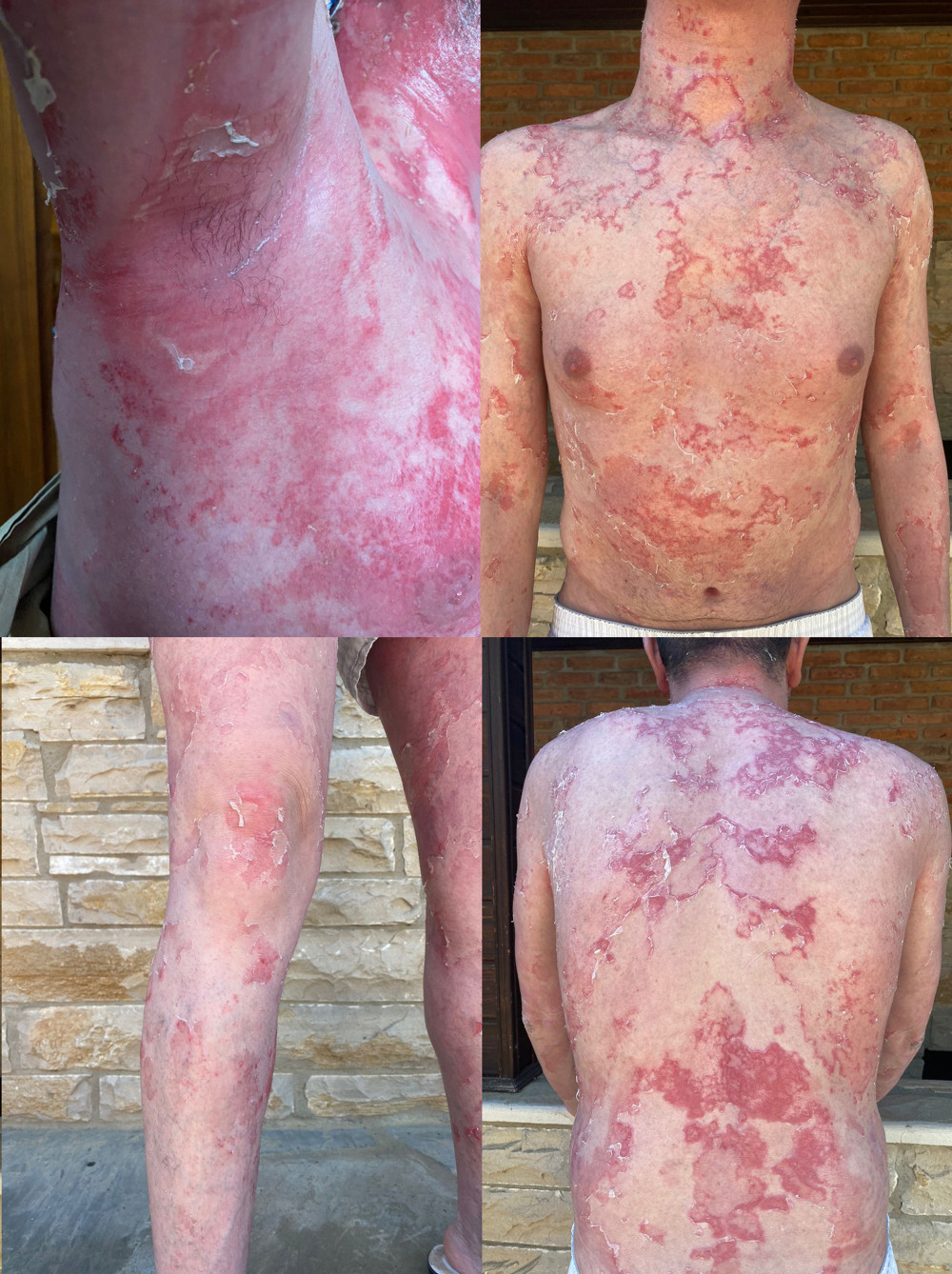 Generalized erythema with polycyclic and serpiginous erythematous plaques with double-edged scales at the margins. Photos taken during the initial examination.