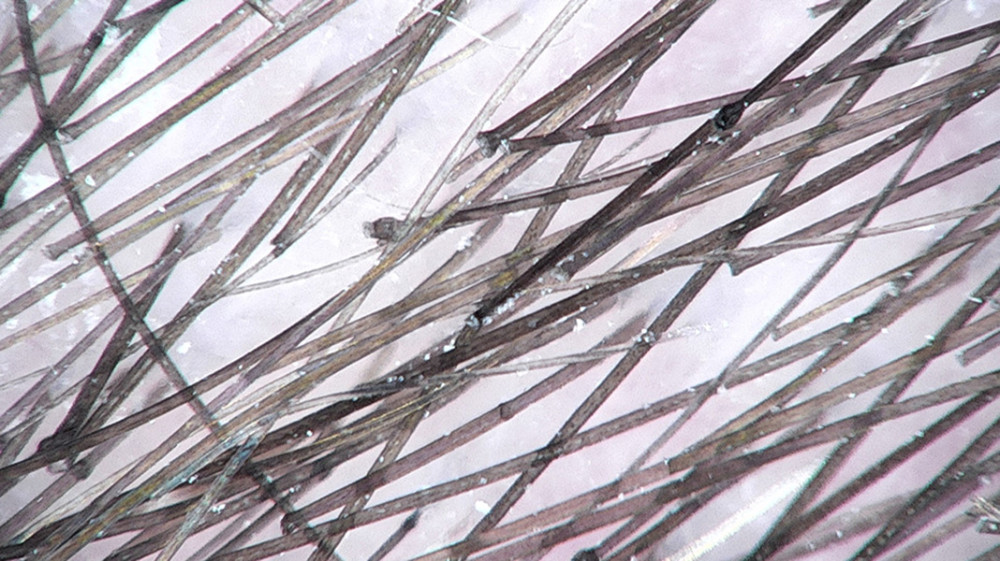 Trichoscopic photo showing trichorrhexis invaginata (bamboo hair), a condition in which the hair shaft invaginates into itself.