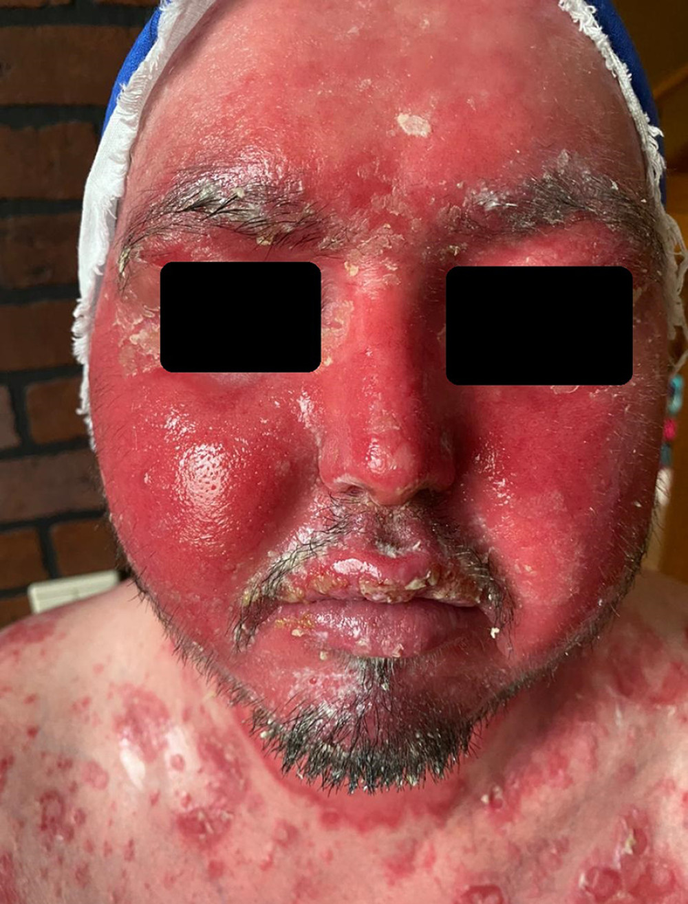Picture of the patient’s face with eczema herpeticum showing erythema, swelling, white to yellow-golden crusts and pustulation.