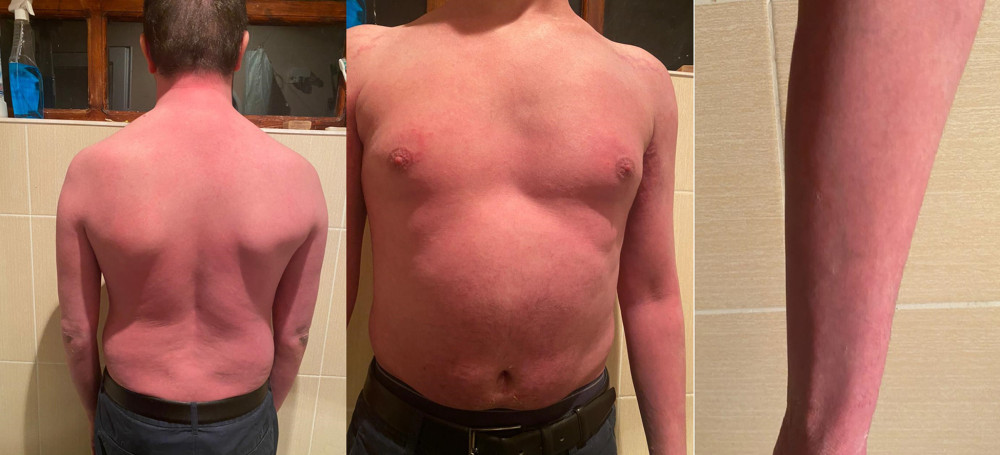 Pictures of the patient after 2 injections of secukinumab. The patient demonstrated mild erythema without scales or plaques.