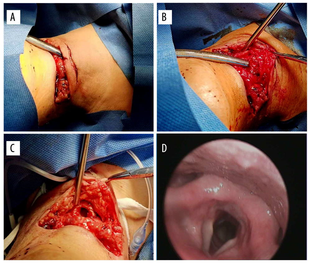 (A) Two wounds were found in front of the patient’s neck, one deep and the other shallow, the longest wound was approximately 10 cm; (B) A cuffed endotracheal tube was inserted through the opening in the injured larynx; (C) The sternothyroid and thyrohyoid muscles were ruptured, part of the cricoid cartilage was defective, the cricoid cartilage was completely disconnected from the first trachea; (D) Dynamic laryngoscopy 1 month after surgery.