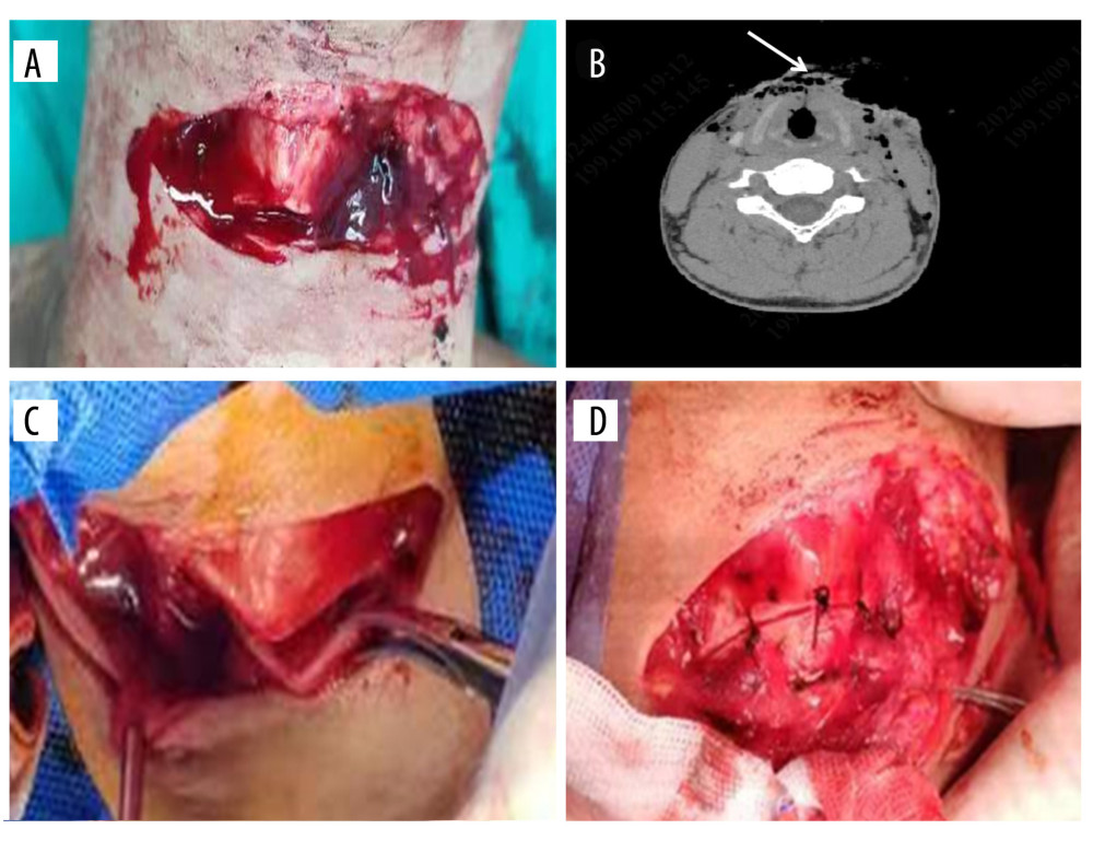 (A, C) The thyroid cartilage plate was transected; (B) Enhanced CT of the neck showed partial tissue defect in the anterior neck and gas accumulation in the surrounding tissue; (D) The sutured thyroid cartilage plate.
