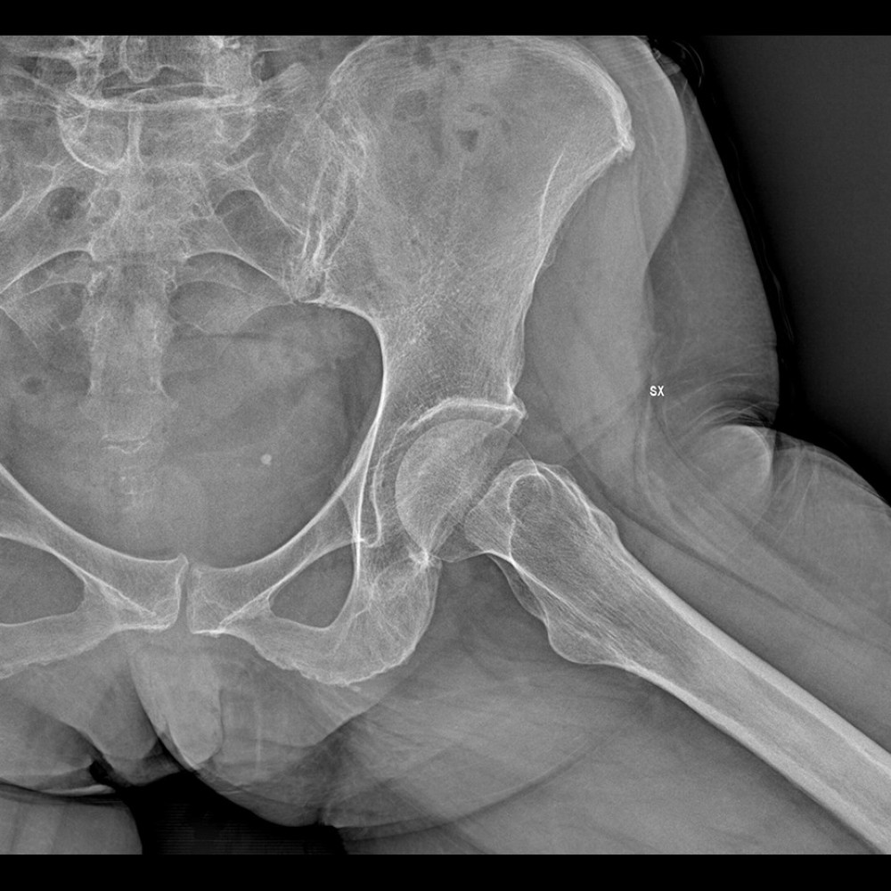 Left-hip X-rays taken 2 months before diagnosis of the atypical fracture of the left femur. The image shows no macroscopic alterations.