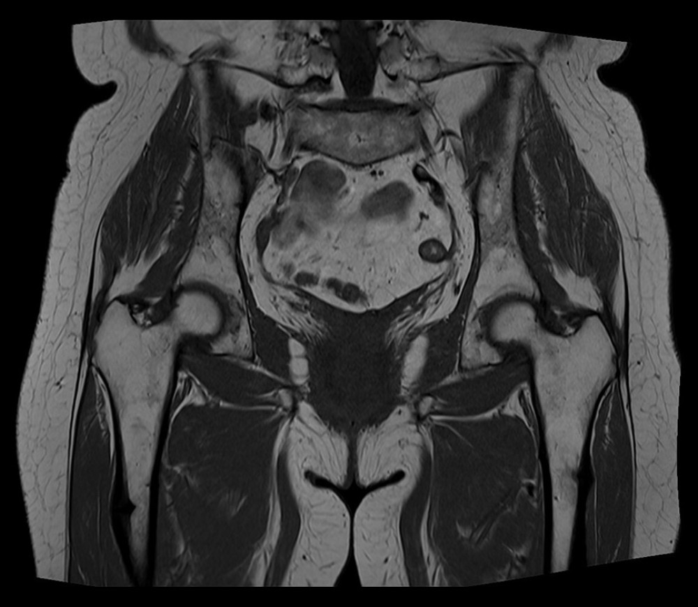Magnetic resonance imaging (MRI) scan of the pelvis, hips, and proximal femurs 1 month before appearance of the proximal left femoral fracture.