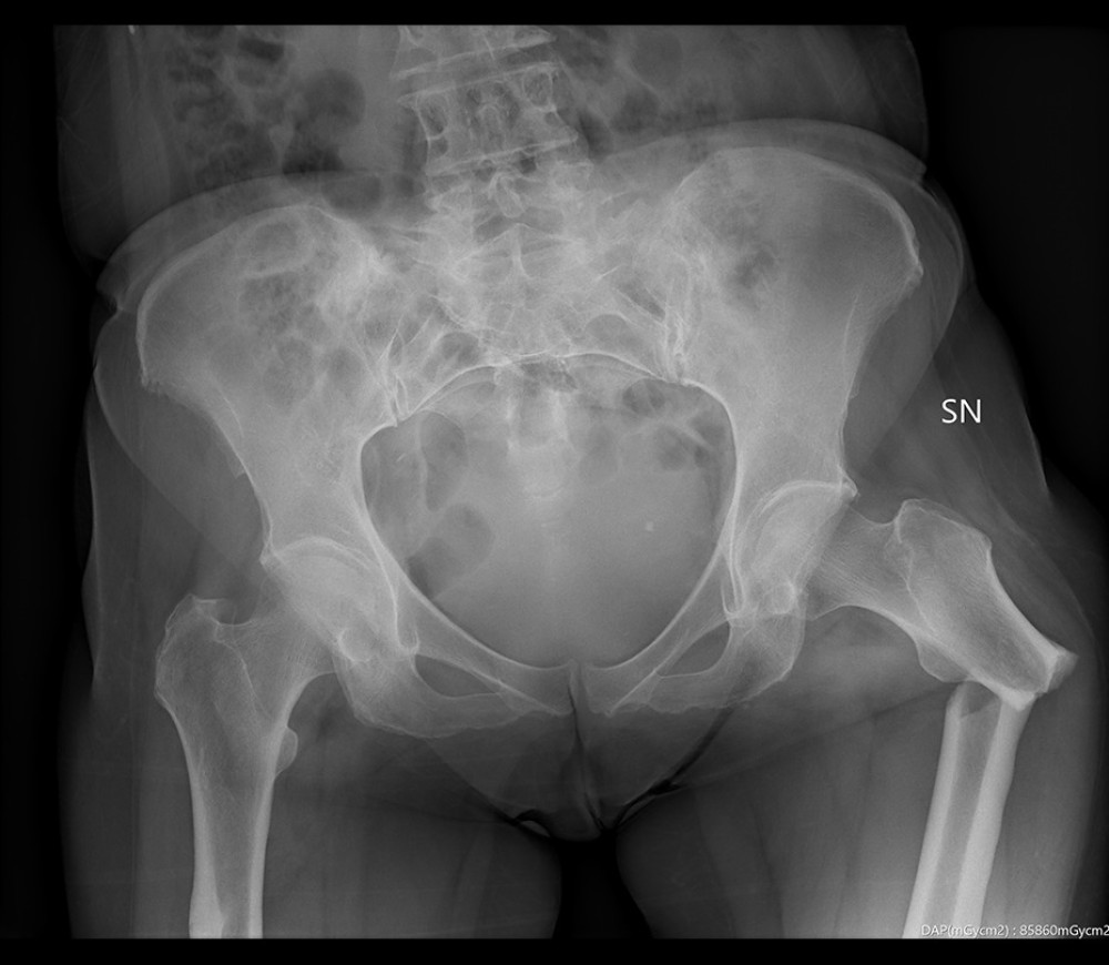 X-ray of pelvis at admission.