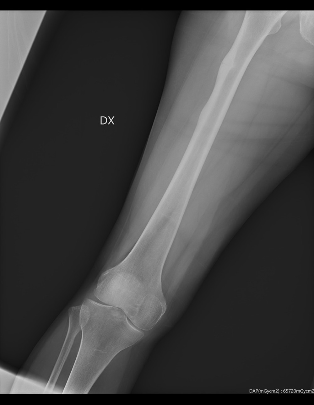 X-ray of right femur at admission.