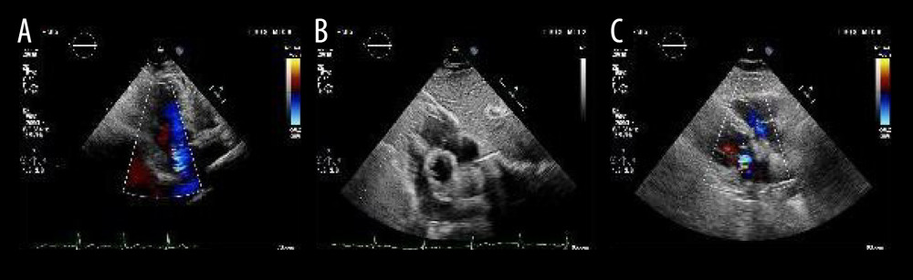 (A–C) Cardiac ultrasound (January 16, 2024) suggested SIT, aortic arteriosclerosis, mild mitral and aortic valve calcification, left ventricular hypodiastolic function, and mild mitral regurgitation.