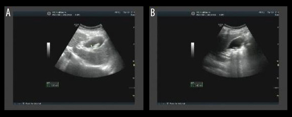 (A, B) Abdominal ultrasound performed on January 16, 2024, revealed thickening and irregularity of the gallbladder wall, and multiple strongly echogenic masses were seen in the lumen with posterior acoustic shadows, the larger of which had a long diameter of about 15 mm. The internal diameter of the common bile duct was about 4 mm, and SIT was apparent.
