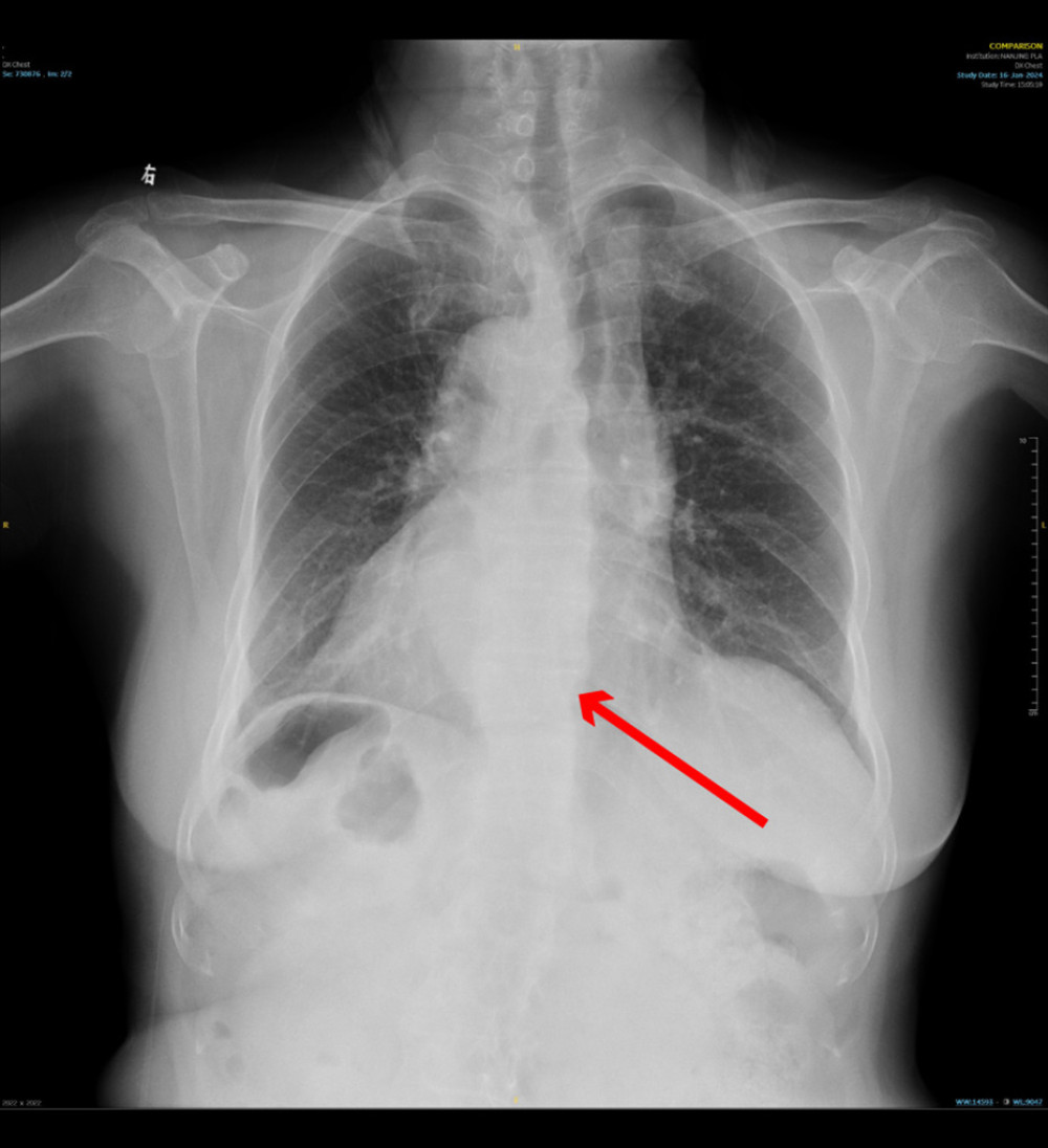 Chest X-ray (January 16, 2024) performed at Jinling Hospital, which is affiliated with Nanjing University, indicated dextrocardia. (The red arrow in the picture refers to the patient’s heart).