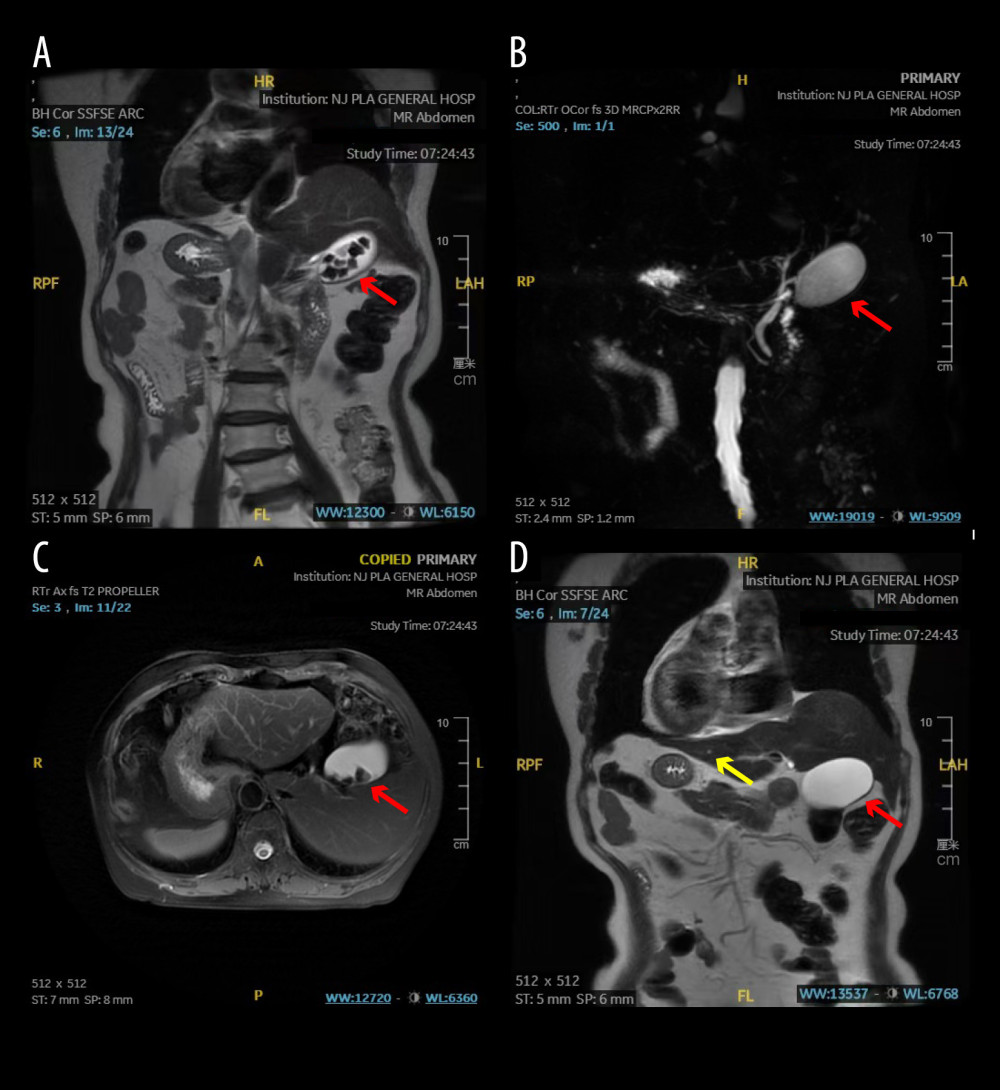 (A–D) MRCP (January 18, 2024) suggested SIT, cholecystolithiasis (the red arrows indicate the patient’s gallbladder), and a 3-mm small hepatic cyst in the right lobe of the liver. (The yellow arrow in Figure D indicates the patient’s hepatic cyst).