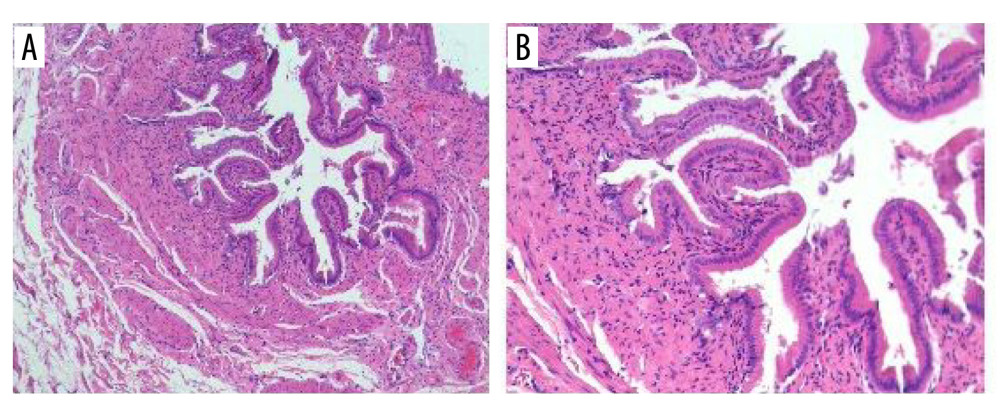 (A, B) Postoperative pathology (January 22, 2024) suggested that the gallbladder stones were accompanied by chronic cholecystitis. The size of the gallbladder was 5.5×3.5×0.6 cm, and the thickness of the gallbladder wall was 0.2 cm.